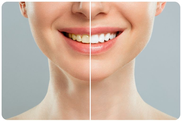 est-ce que la cigarette électronique fait jaunir les dents